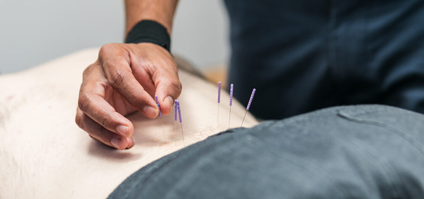 dry needling being performed by Werribee Physiotherapist